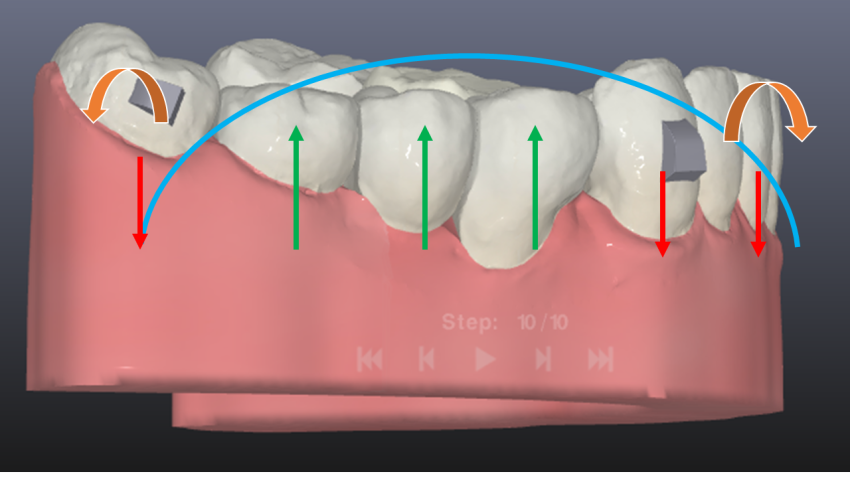 Alinhador x Bráquetes na correção da Curva de Spee